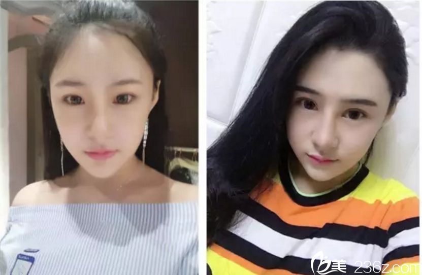 郴州唯美整形雙眼皮真人案例