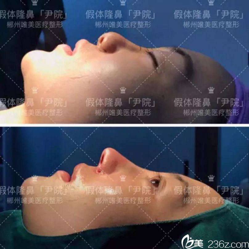 郴州唯美醫(yī)療整形假體隆鼻真人案例