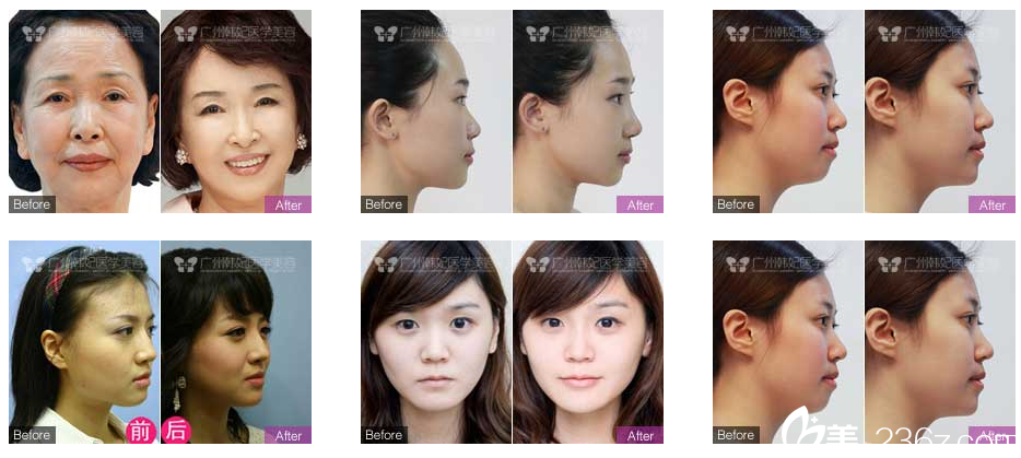 廣州韓妃陳坦醫(yī)生案例