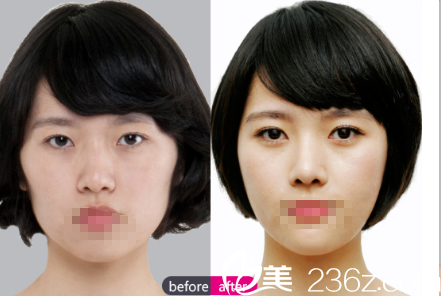 楊建鼻綜合+面部脂肪填充案例 楊建鼻綜合+面部脂肪填充案例