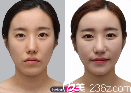 楊建面部脂肪填充精雕案例對比照 楊建面部脂肪填充精雕案例對比照