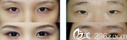 太原美媛薈李莉婷醫(yī)師眼綜合案例 太原美媛薈李莉婷醫(yī)師眼綜合案例