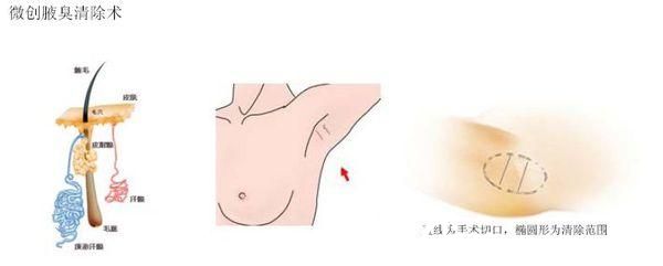 余繼平醫(yī)生祛腋臭微創(chuàng)手術(shù)原理 余繼平醫(yī)生祛腋臭微創(chuàng)手術(shù)原理