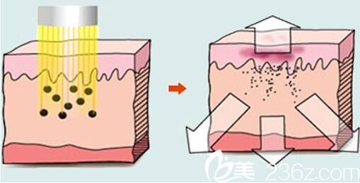 激光祛黃褐斑原理 激光祛黃褐斑原理