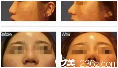 哈爾濱仁美線雕l隆鼻案例