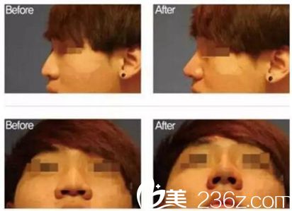 哈爾濱仁美鼻綜合案例