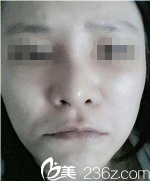 鼻梁低鼻翼寬大