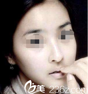 隆鼻后我的鼻子會變成什么樣