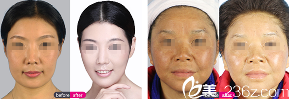楊才華皮膚美容案例對比圖 楊才華皮膚美容案例對比圖