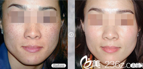 楊才華去雀斑治療后對比照片 楊才華去雀斑治療后對比照片