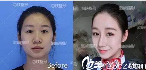 濟南海峽醫(yī)院假體隆鼻手術(shù)效果