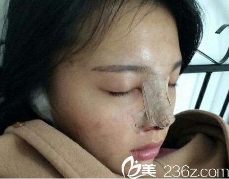 濟南海峽醫(yī)院假體隆鼻手術(shù)當(dāng)天后的照片
