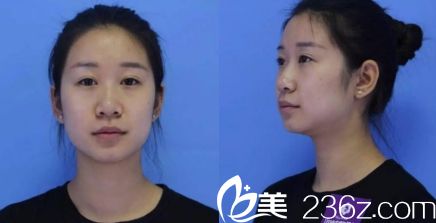 濟南海峽醫(yī)院假體隆鼻手術(shù)術(shù)前圖片