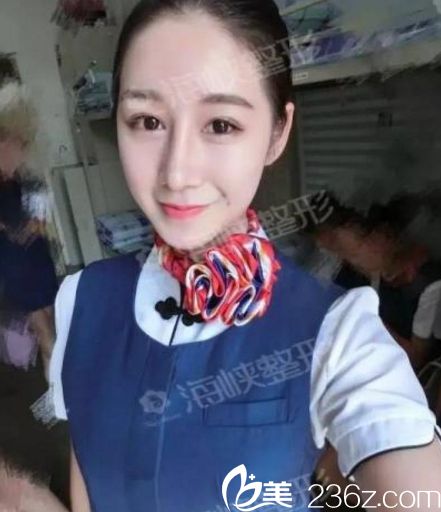 濟南海峽醫(yī)院假體隆鼻手術(shù)一個月后效果