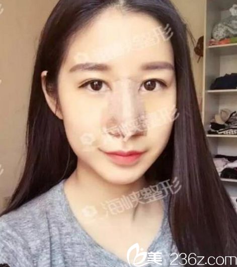 濟南海峽醫(yī)院假體隆鼻手術(shù)一周后效果