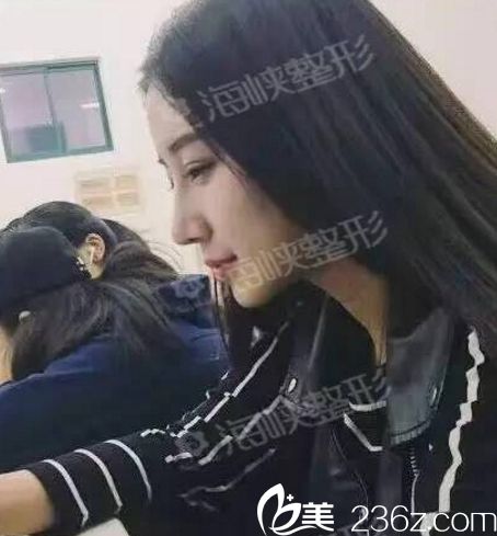 濟南海峽醫(yī)院假體隆鼻手術(shù)效果怎么樣