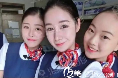 濟南海峽醫(yī)院假體隆鼻手術(shù)效果兩個月后效果