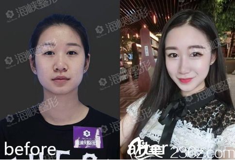 濟南海峽醫(yī)院假體隆鼻手術(shù)前后對比圖片