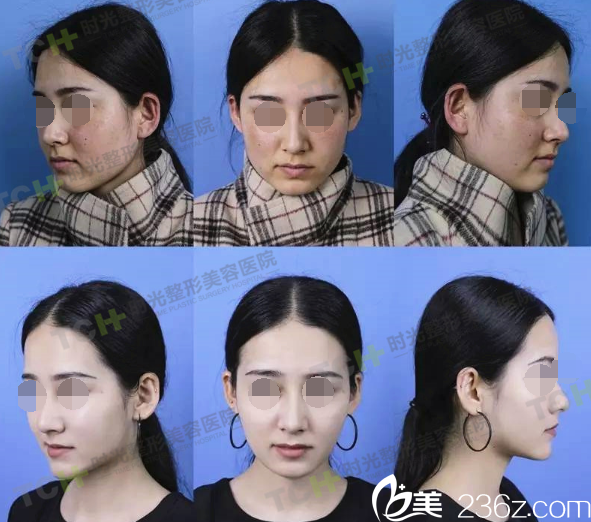 新疆女<!--<i data=20240703-sp></i>-->生時(shí)光祛斑治療前后