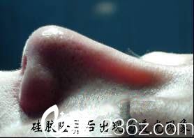 硅膠假體有透光的可能