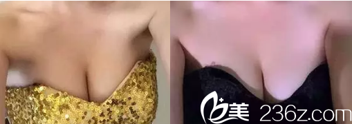 韓國(guó)麥恩醫(yī)院李圣郁院長(zhǎng)motiva假體隆胸真人案例