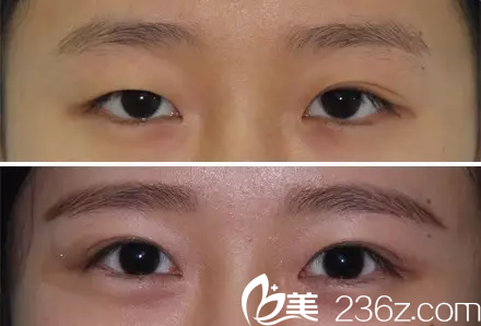 北京黃寺美容外科醫(yī)院汪立川—眼部案例