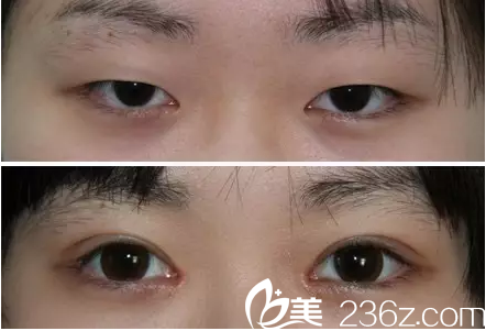 北京黃寺美容外科醫(yī)院汪立川眼部整形北京黃寺美容外科醫(yī)院汪立川案例