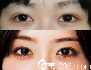 北京黃寺美容外科醫(yī)院汪立川案例對(duì)比