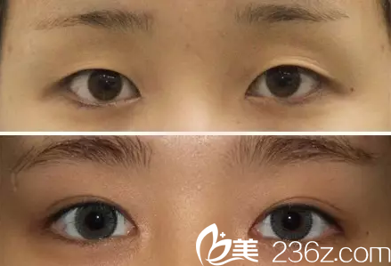 北京黃寺美容外科醫(yī)院汪立川——案例三