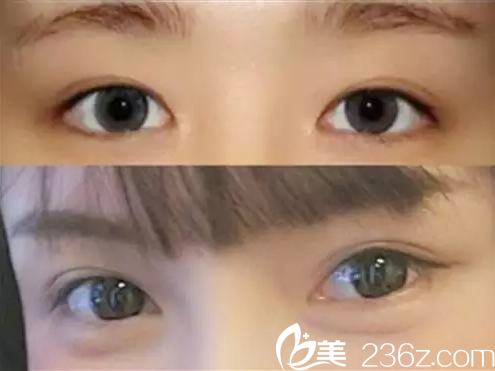 北京黃寺美容外科醫(yī)院汪立川案例對(duì)比2