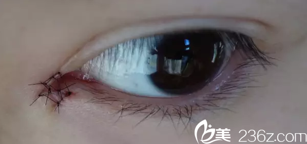 北京黃寺美容外科醫(yī)院汪立川內(nèi)眼角縫線