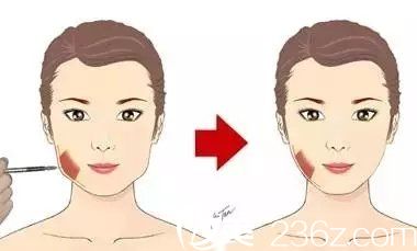 瘦臉注射位置