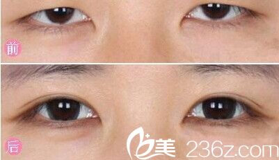 韓國(guó)will醫(yī)院治療上瞼下垂