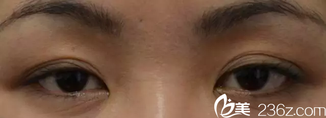 韓國(guó)will醫(yī)院——上瞼皮膚下垂變成三眼皮