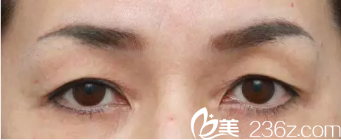 上瞼皮膚下垂變成三角眼—韓國(guó)will醫(yī)院魏亨坤