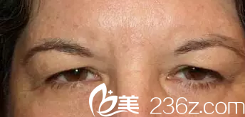 上瞼皮膚下垂變成三角眼——韓國(guó)will醫(yī)院