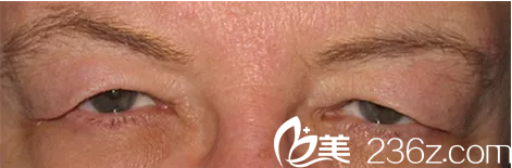 上瞼皮膚松弛下垂影響視力——韓國(guó)will醫(yī)院