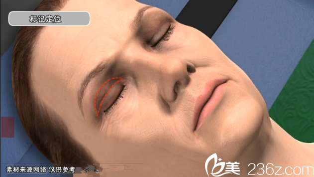 上瞼皮膚松弛下垂——切開(kāi)雙眼皮法——韓國(guó)will醫(yī)院魏亨坤