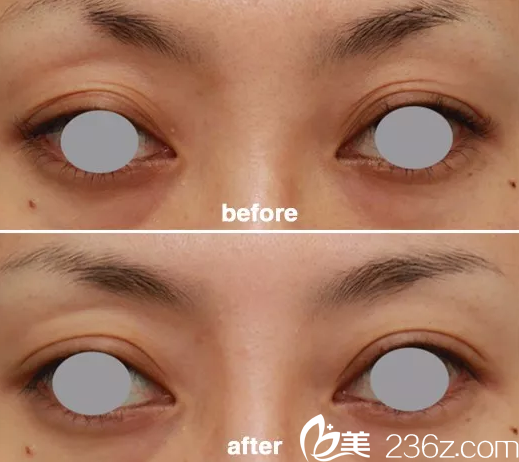 上瞼皮膚松弛下垂——韓國(guó)will醫(yī)院雙眼皮切開(kāi)案例