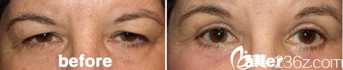 上瞼皮膚松弛下垂—韓國(guó)will醫(yī)院——改善眼部形態(tài)