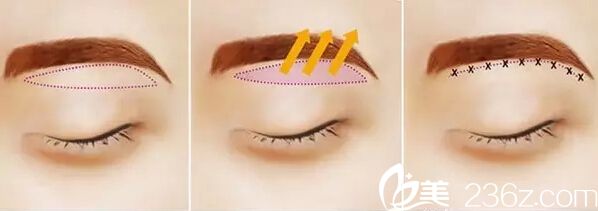 韓國(guó)will醫(yī)院切眉手術(shù)方法示意圖