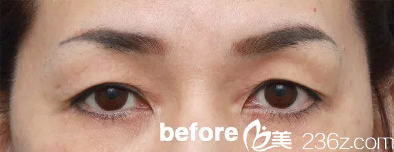 韓國(guó)will醫(yī)院切眉手術(shù)術(shù)前