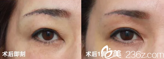 韓國(guó)will醫(yī)院切眉手術(shù)術(shù)后一周