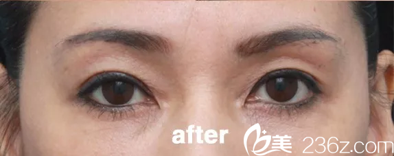 韓國(guó)will醫(yī)院切眉手術(shù)術(shù)后