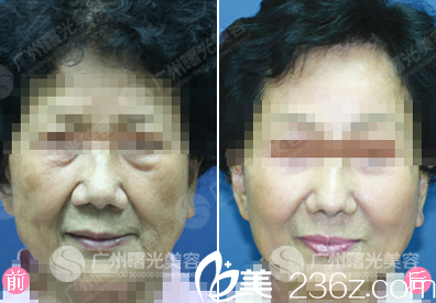  廣州曙光蔣晟中面部拉皮術案例對比圖
