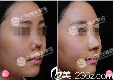 廣州曙光蔣晟鼻再造案例