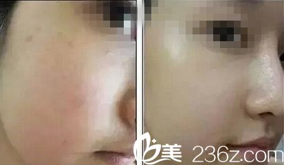 原辰醫(yī)院注射真人案例前后對比照片