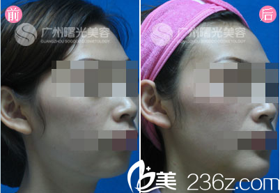 廣州曙光劉永波隆下頦案例