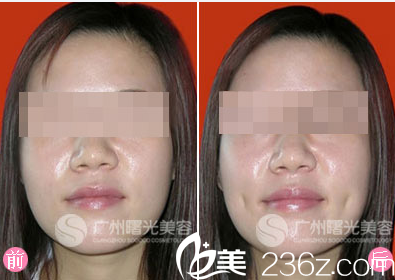 廣州曙光王娟酒窩成型術案例效果