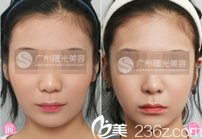 廣州曙光王娟面部填充案例